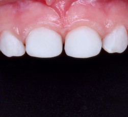 Профессиональная чистка зубов